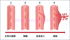 大動脈解離進行の図。
