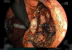 吐血で緊急検査時の内視鏡所見。胃体部小弯側に、凝血塊の付着した深掘れ潰瘍を認める。