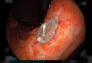 治療効果判定のために胃カメラを施行。潰瘍の縮小と、肉芽組織増殖を認め、快方に向かいつつある。