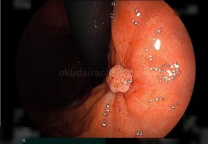 潰瘍がほぼふさがっている。潰瘍中心部に柔らかい肉芽組織の膨隆がある。