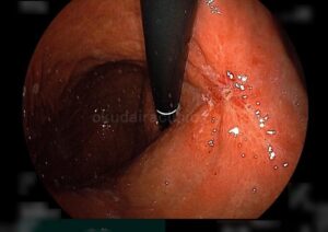 膨隆部は消失しているが、潰瘍中心部はびらんを有し、不規則に変形している。
