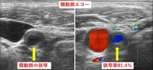 頸動脈狭窄像。