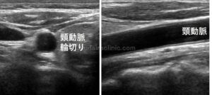 正常頸動脈像