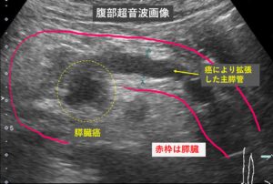 膵臓癌の超音波画像。点線内に境界不明瞭な腫瘤影が確認できる。